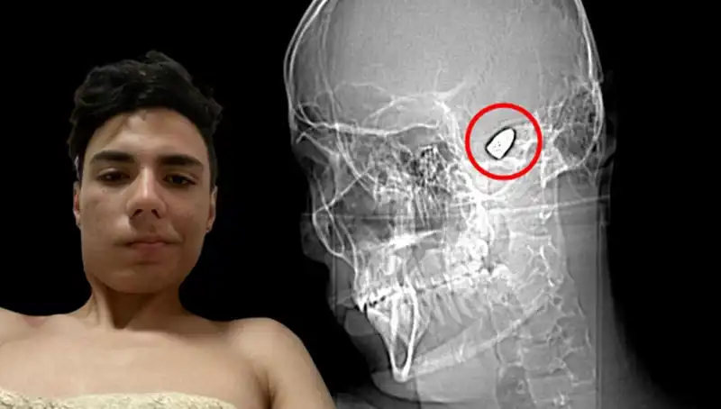 Kafasında Patlayan Bir Bomba ile Yaşayan Genç: Hayatta Kalma Mücadelesi
