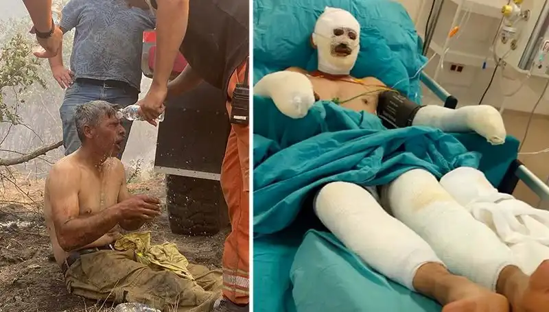 Yanıyorum Diye Feryat Eden Orman İşçisinin Tedavisi Devam Ediyor!