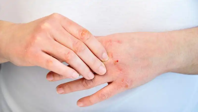 Protein Yetersizliği Belirtileri: 6 İşareti Gözden Kaçırmayın!