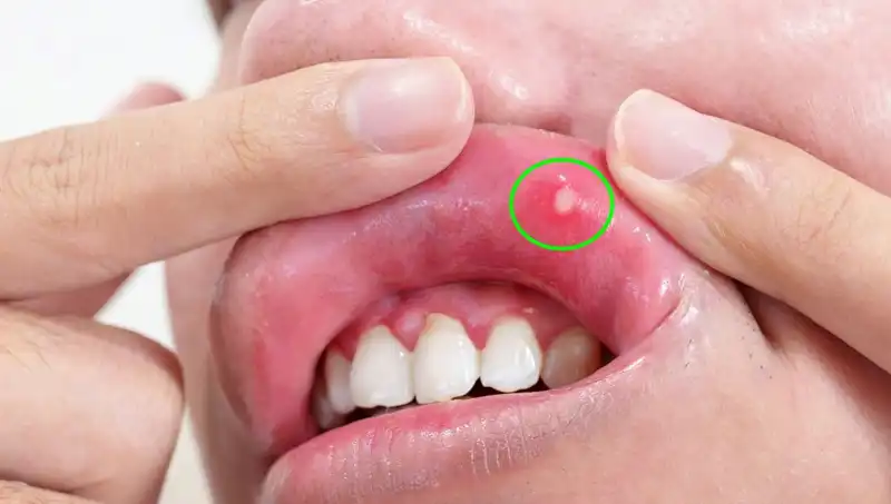 B vitamini Eksikliği: Vücudunuzun Gösterdiği 5 Belirgin Belirti