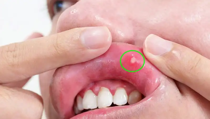 Kanserin Sessiz Uyarısı: Hastanın Dili Alınmak Zorunda Kaldı
